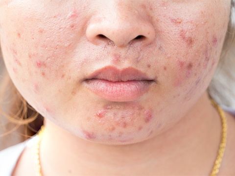 1月から注意が必要 花粉症による肌荒れ対策 スキンケア大学