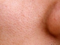 頬の毛穴の開きを引き締める正しい4つの改善方法