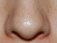 鼻 ワセリン いちご いちご鼻にある毛穴の黒ずみはどうしたらいい？｜あしたの美肌｜専門家による美容コラム