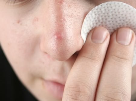 医師監修 鼻の毛穴詰まりを解消する方法 鼻の角栓を落とせる洗顔とケア スキンケア大学