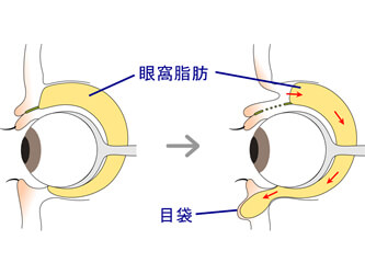 眼窩脂肪が眼球の重みに押され前にせり出し、膨らみができる解説図