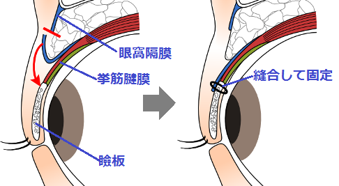 眼瞼挙筋腱膜前転術（がんけんきょきんけんまくぜんてんじゅつ）